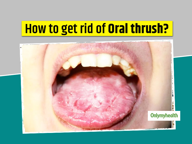 Want To Get Rid Of Oral Thrush? Here Are 10 Home Remedies To Help Naturally